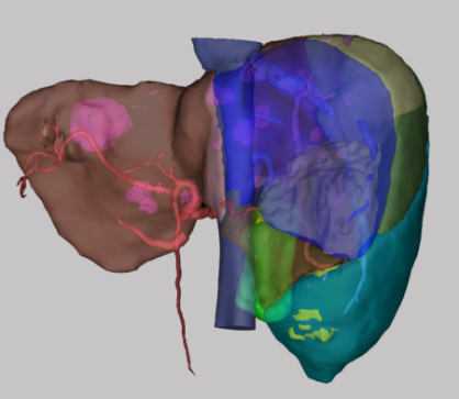 基于3D打印的肝脏精准切除手术用实体模型实现方法研究